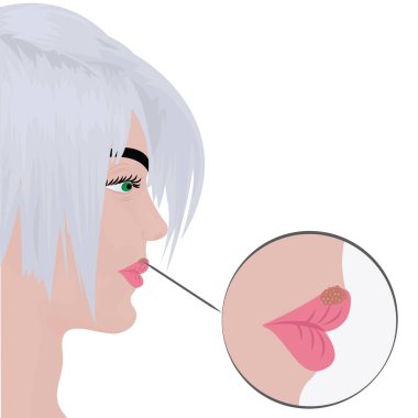 Kadın dudaklarında herpes soğuk yaralar