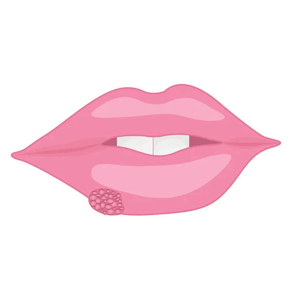 Una boca con herpes labial en los labios — Vector de stock