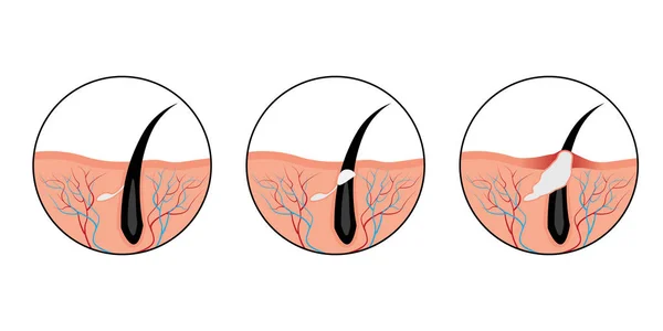 Acne uhry vyvíjí — Stockový vektor