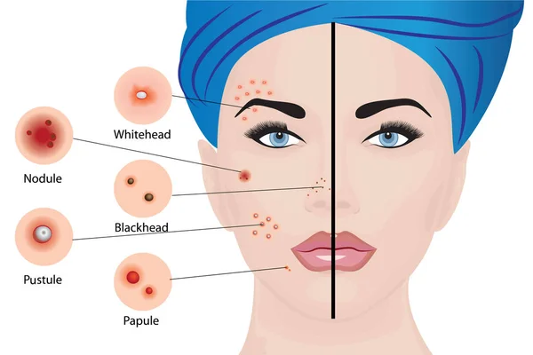 Tipos de acne no rosto de uma mulher —  Vetores de Stock