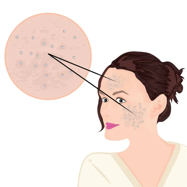 Acne on a face — Stock Vector