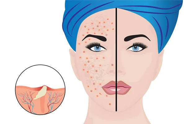 Pustulas de acne no rosto de uma mulher e um resultado do tratamento —  Vetores de Stock
