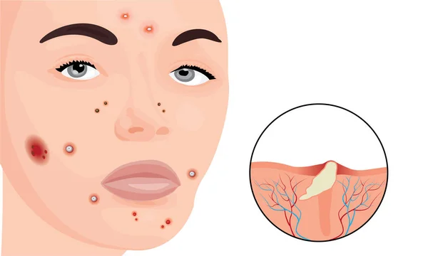 Akne auf dem Gesicht einer Frau — Stockvektor