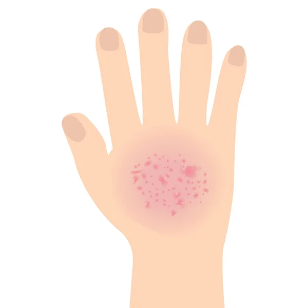 Eczema afecta a una mano Dermatología concepto de enfermedad de la piel — Vector de stock