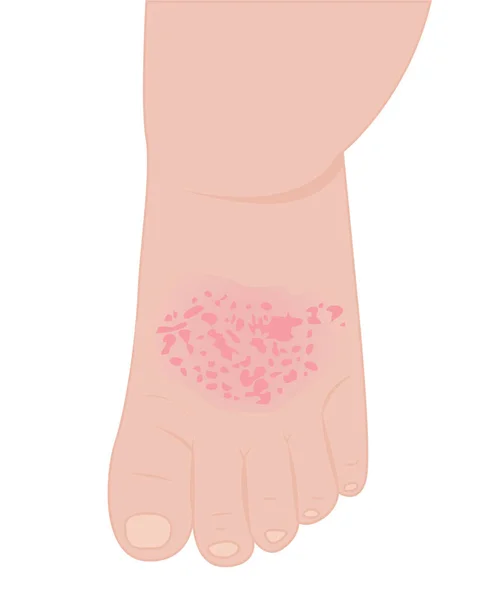 Un pie de bebé afectado con eczema — Vector de stock