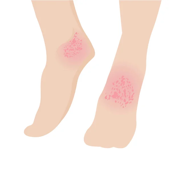 Екзема вплинула на шкіру ноги дерматологічні захворювання — стоковий вектор