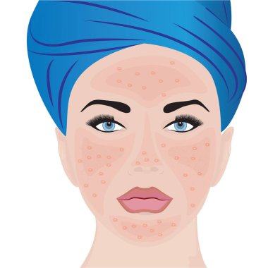 Rosacea moderate on a woman face clipart
