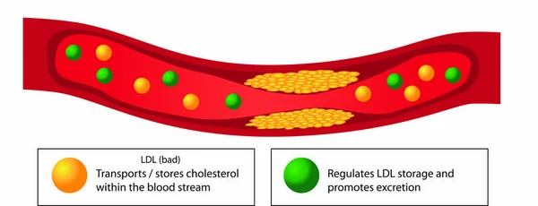 血管におけるアテローム硬化性プラークと良い脂質ベクターベクターインフォグラフィック — ストックベクタ