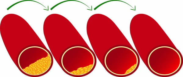 Limpiar Enrojecer Sangre Los Vasos Sanguíneos Ilustración Vector Placa Aterosclerótica — Archivo Imágenes Vectoriales