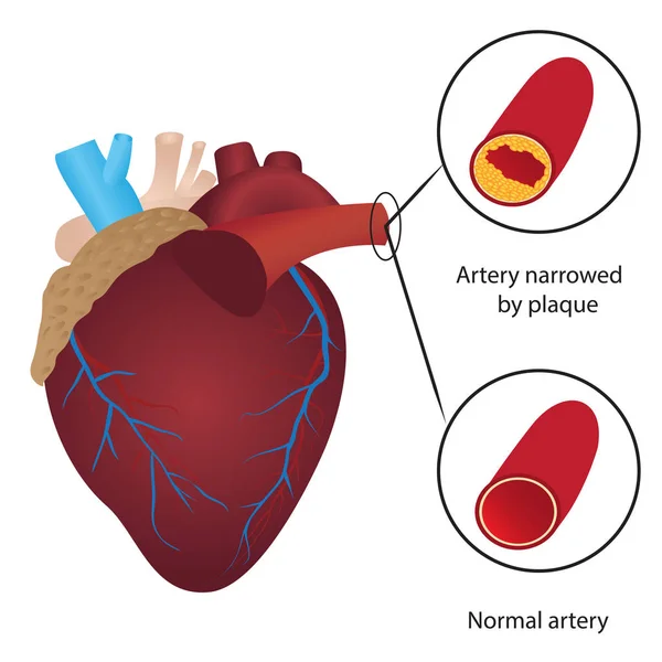 Hladina Cholesterolu Nákresu Krevní Cévy — Stockový vektor