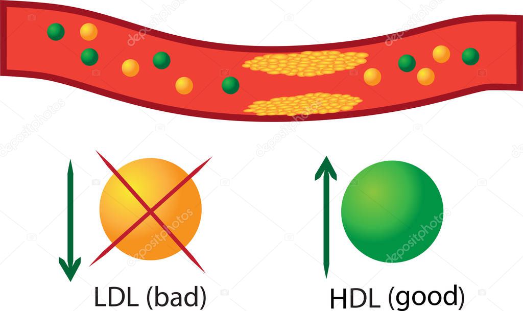 Atherosclerotic plaque in blood vessel, good and bad lipids their regulation in blood vector infographics