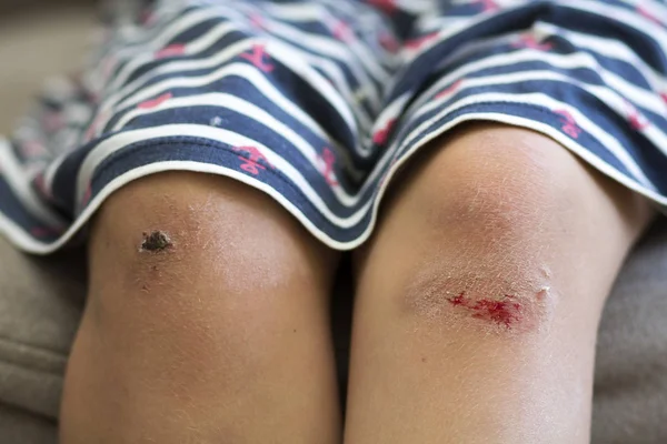 Primer Plano Una Niña Pequeña Con Moretones Las Rodillas Lesionadas —  Fotos de Stock