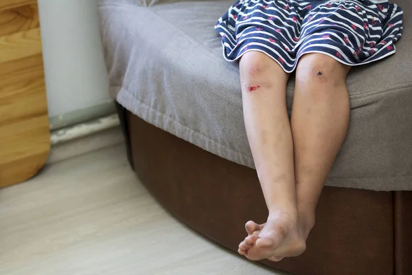 Close Young Child Girl Barefooted Legs Bruised Damaged Injured Knees — Stock Photo, Image