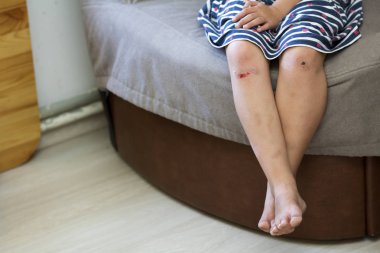 Kız Genç çocuk Close-up yalınayak çürük hasarlı yaralı diz ile eski izleri ve taze kan ile düştükten sonra bacaklar. Çocuk travmalar, kazalar ve tedavi, sorunları büyüyen-up kavramının.
