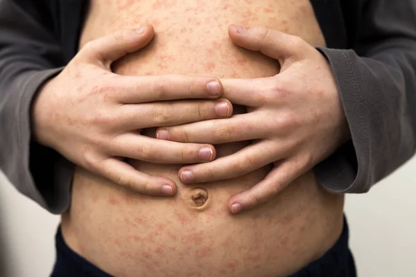 Cuerpo de niño enfermo, estómago con manchas rojas de sarampión o chi — Foto de Stock