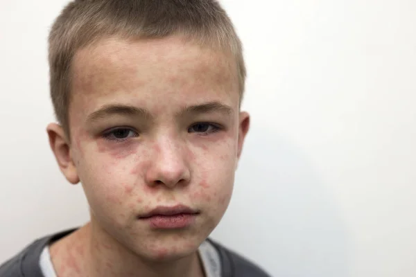 Porträtt av sjukt sorgsen pojke barn som lider av mässling eller kyckling — Stockfoto
