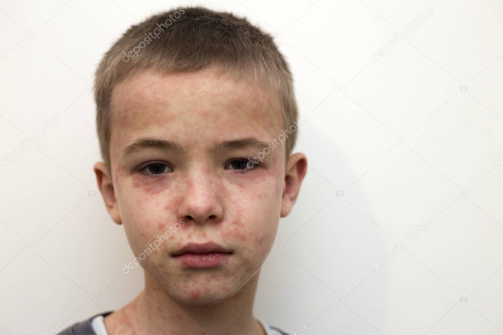 Portrait of sick sad boy child suffering from measles or chicken pox with bumps all over face. Contagious child diseases and treatment.