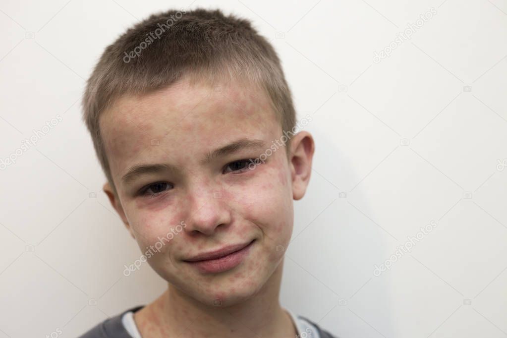 Portrait of sick smiling boy child suffering from measles or chi