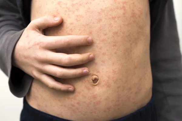 Sick child body, stomach with red rush spots from measles or chi