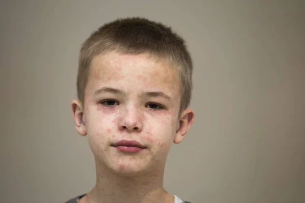 Retrato de niño triste enfermo que sufre de sarampión o pollo —  Fotos de Stock