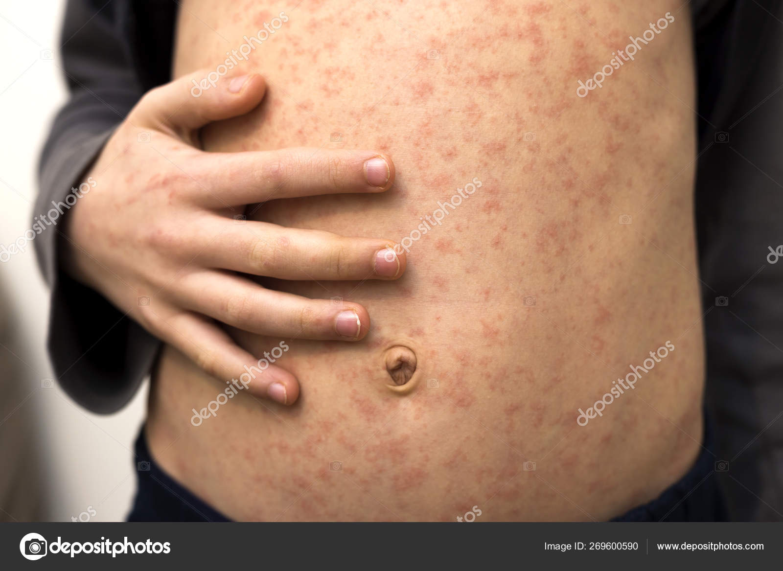 Sick child body, stomach with red rush spots from measles or chicken pox.  Contagious child diseases and treatment. Stock Photo by ©bilanol.i.ua  269600590