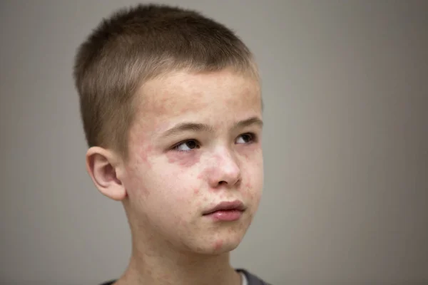 Retrato de niño triste enfermo que sufre de sarampión o pollo —  Fotos de Stock