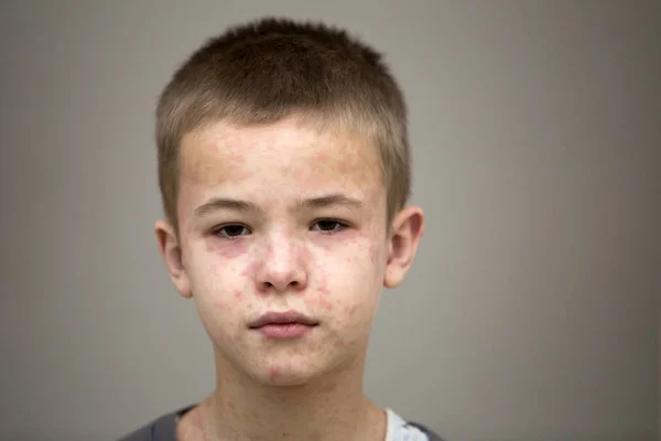 Retrato de niño triste enfermo que sufre de sarampión o pollo —  Fotos de Stock