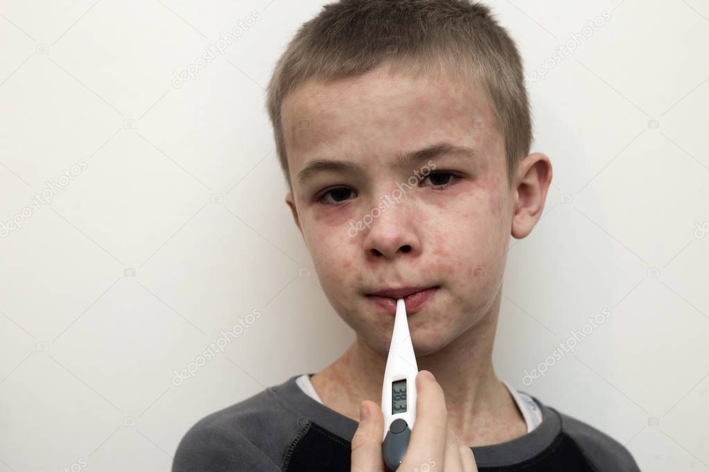 Portrait of sick sad boy child with thermometer having fever suffering from measles or chicken pox with bumps all over face. Contagious child diseases and treatment.