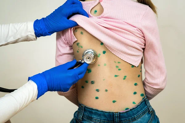 Lekarz Badający Dziecko Stetoskopem Pokrytym Zielonymi Wysypkami Plecach Chorych Ospę — Zdjęcie stockowe