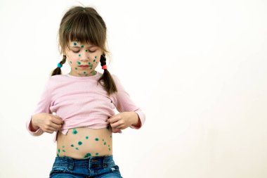 Child girl covered with green rashes on face and stomach ill with chickenpox, measles or rubella virus. clipart