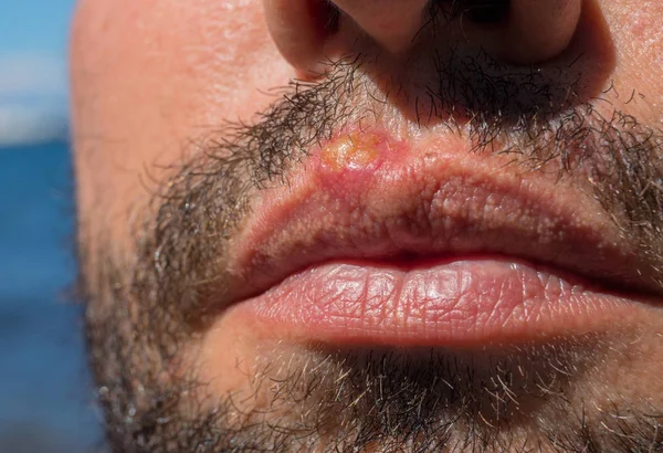 Sunburn on man lips closeup. Sun burn or bacterial infection on skin. Skin medical problem. Virus or bacterial inflammation