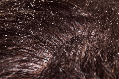 Koyu saçlı kuru kafa derisi sorunu.