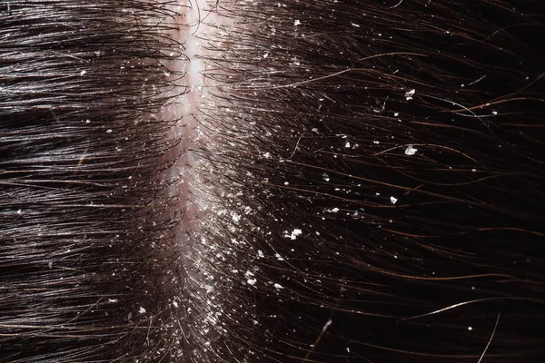 Masalah Kulit Kepala Kering Pada Rambut Hitam — Stok Foto