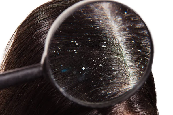 Πρόβλημα Του Ξηρού Τριχωτού Της Κεφαλής Σκούρα Μαλλιά — Φωτογραφία Αρχείου