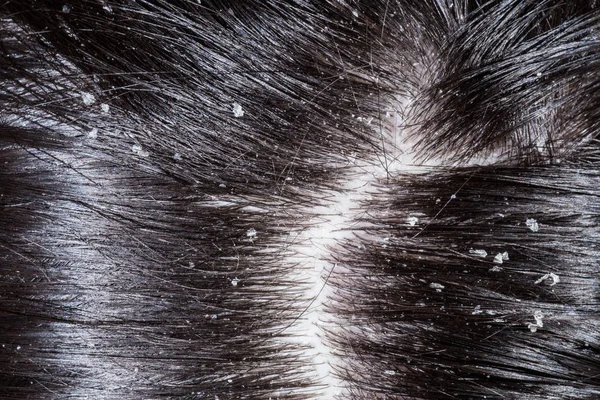 Проблема Сухого Шкіри Голови Темному Волоссі — стокове фото