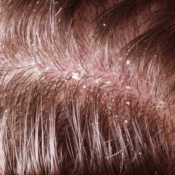 Pellicules sur cheveux foncés masculins — Photo