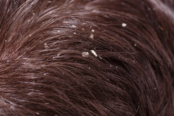 Dandruff on male dark hair — Stock Photo, Image