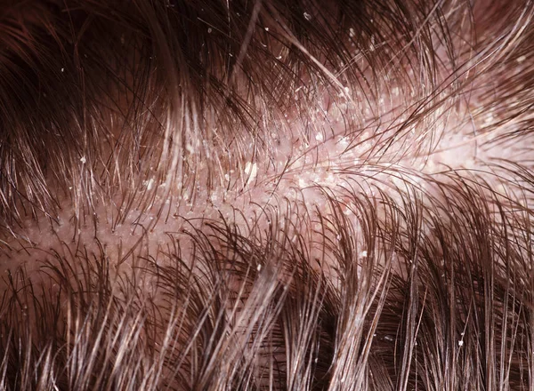 Dandruff on male dark hair — Stock Photo, Image