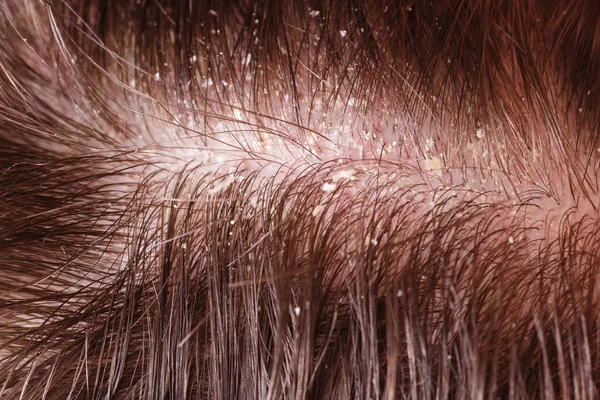 Caspa en cabello oscuro masculino — Foto de Stock