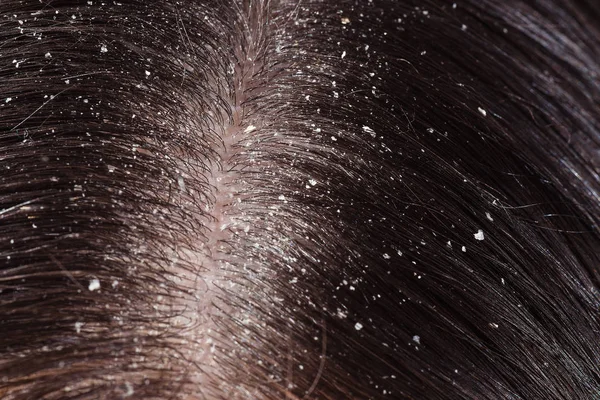 Dandruff on woman's dark hair — Stock Photo, Image