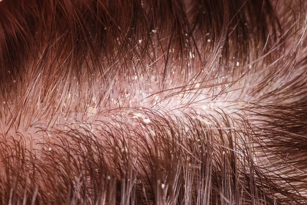 Πιτυρίδα σε αρσενικό σκούρα μαλλιά — Φωτογραφία Αρχείου