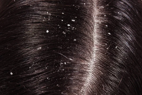 Dandruff on her dark hair — Stock Photo, Image