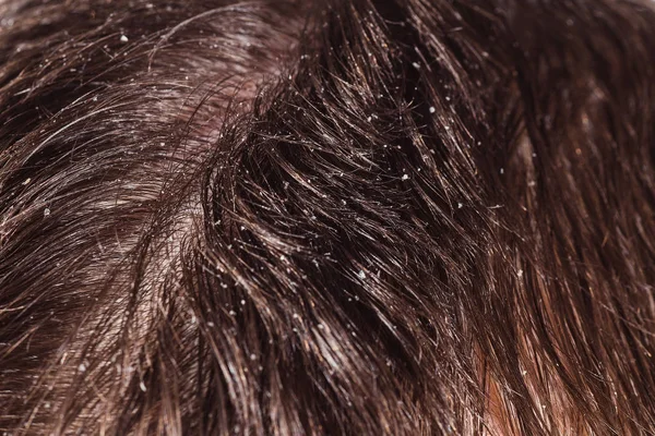 Dandruff on male dark hair — Stock Photo, Image