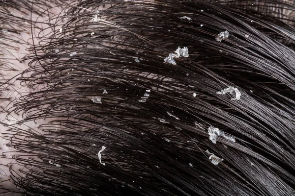 Dandruff on her dark hair — Stock Photo, Image