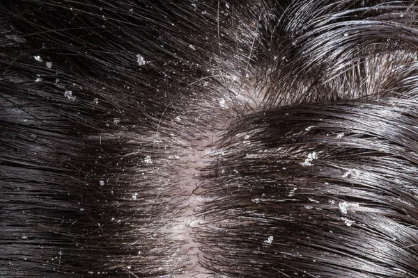Dandruff on her dark hair — Stock Photo, Image