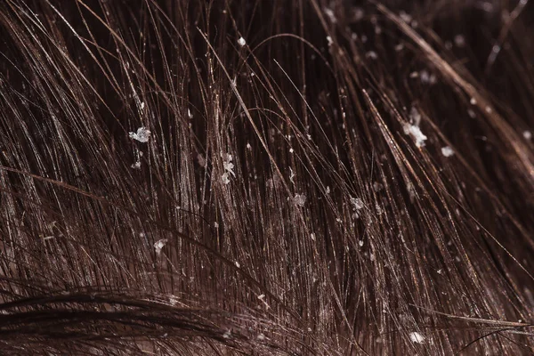 Dandruff on male dark hair — Stock Photo, Image