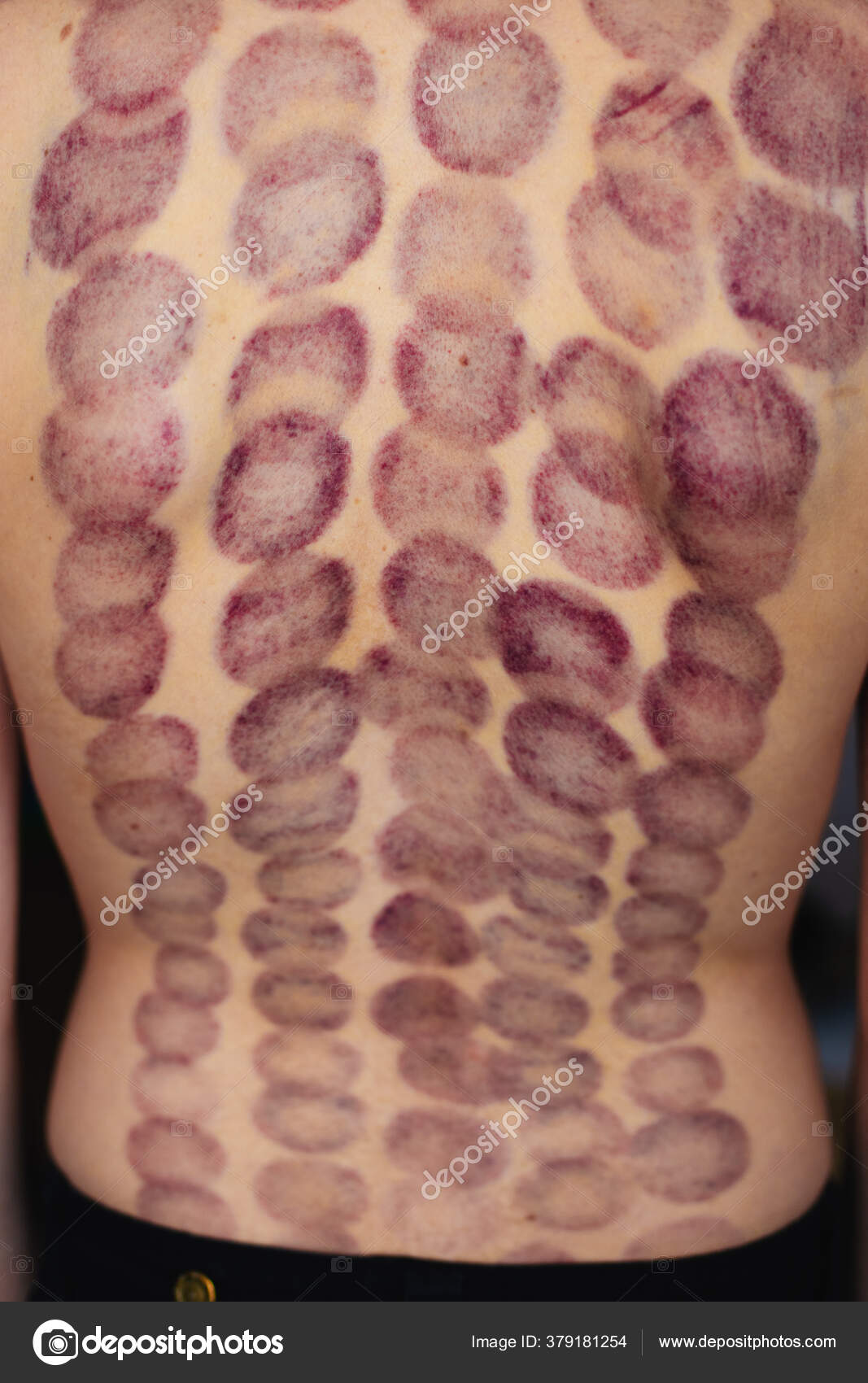 Rastros Espalda Una Mujer Joven Después Del Procedimiento Masaje