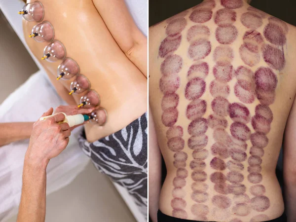 Young woman on the procedure of vacuum cupping massage and bruises on the back as a consequence. collage