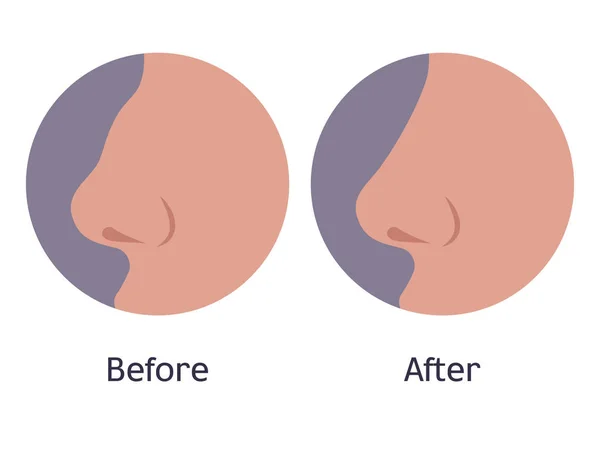 整形手术前后的鼻子 — 图库矢量图片
