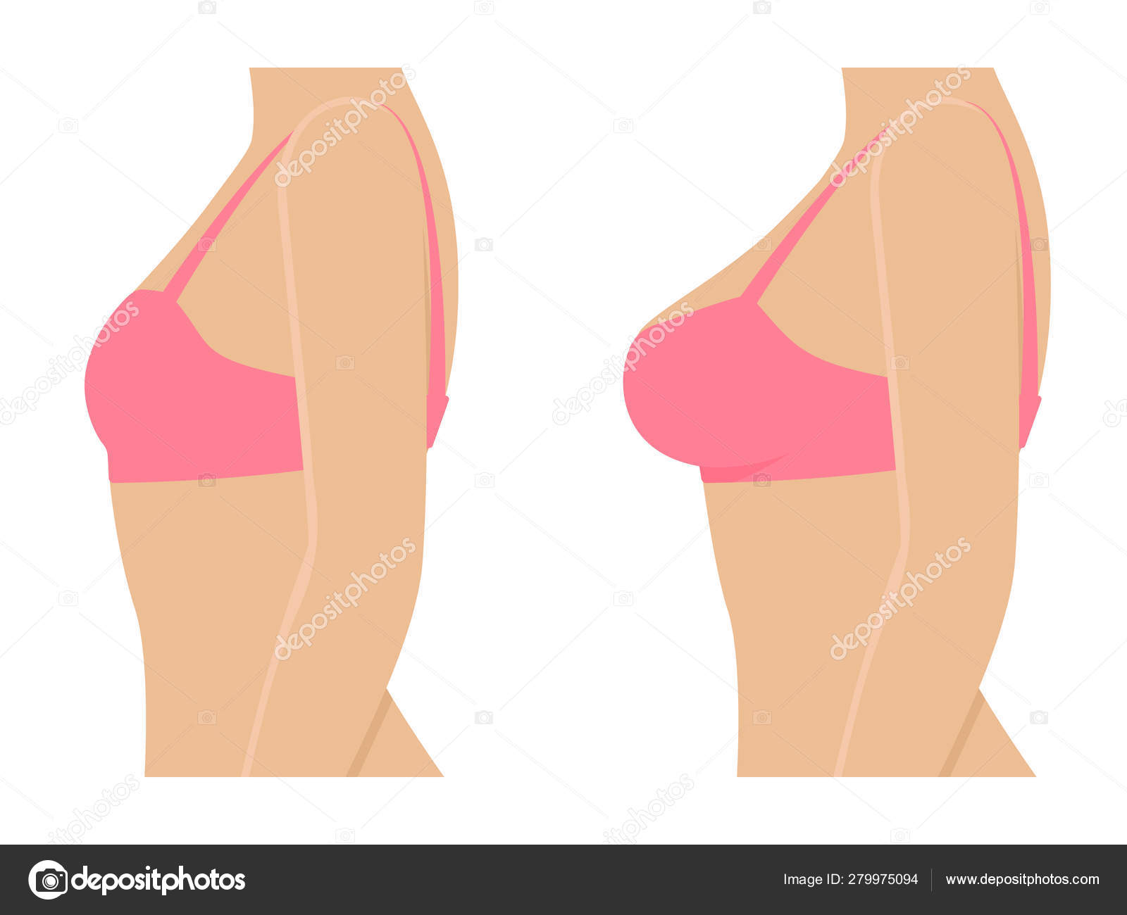 Female breasts in bra before after augmentation Stock Vector by  ©jenyakot86.gmail.com 279975094
